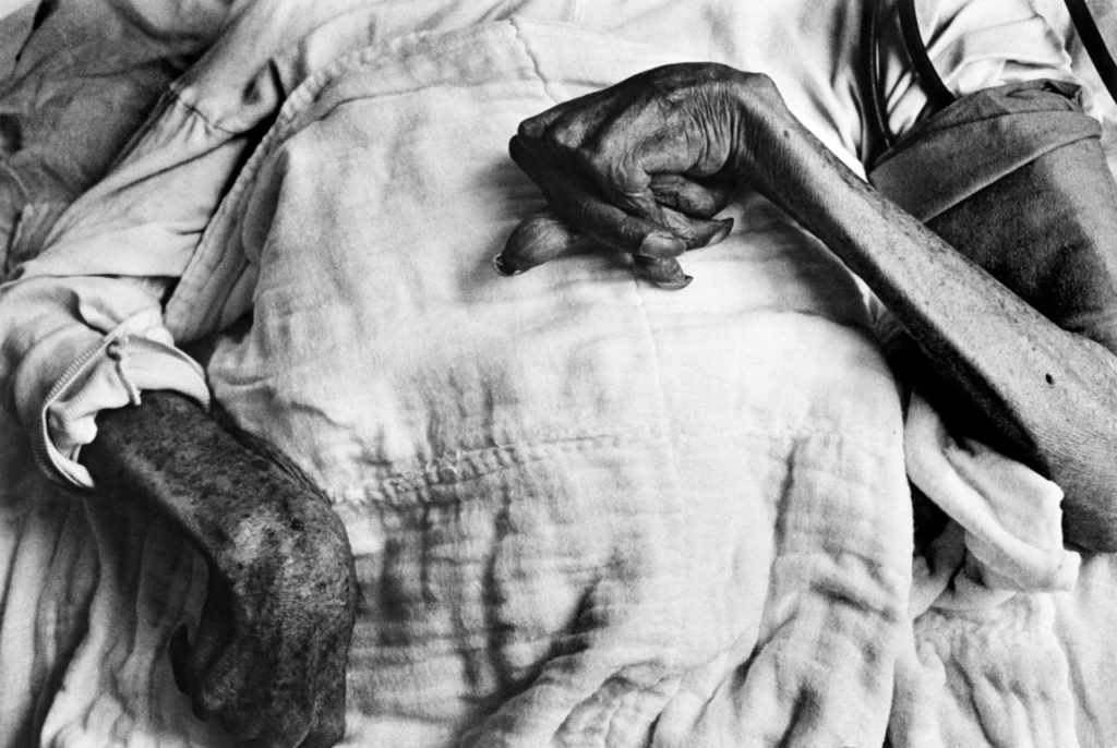 Victima-de-la-enfermedad-de-Minamata-Eugene-Smith-1971